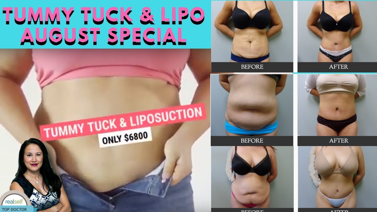 Tummy Tuck & Liposuction Specials | Abdominoplasty | El Paso Tx | Dr Anh Lee