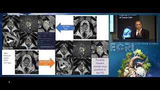 ECR 2025: Deep Learning Reconstruction in Prostate MRI