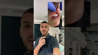 Komplikacija Biopolimera.