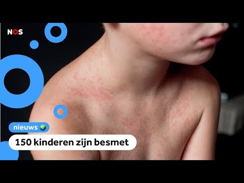 Video: Mazelen Bij Kinderen - Symptomen, Behandeling, Tekenen, Preventie, Vaccinatie
