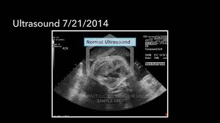 Birth Injury Animation - Baby Normal Through Prenatal Development @HighImpactLegalExhibits