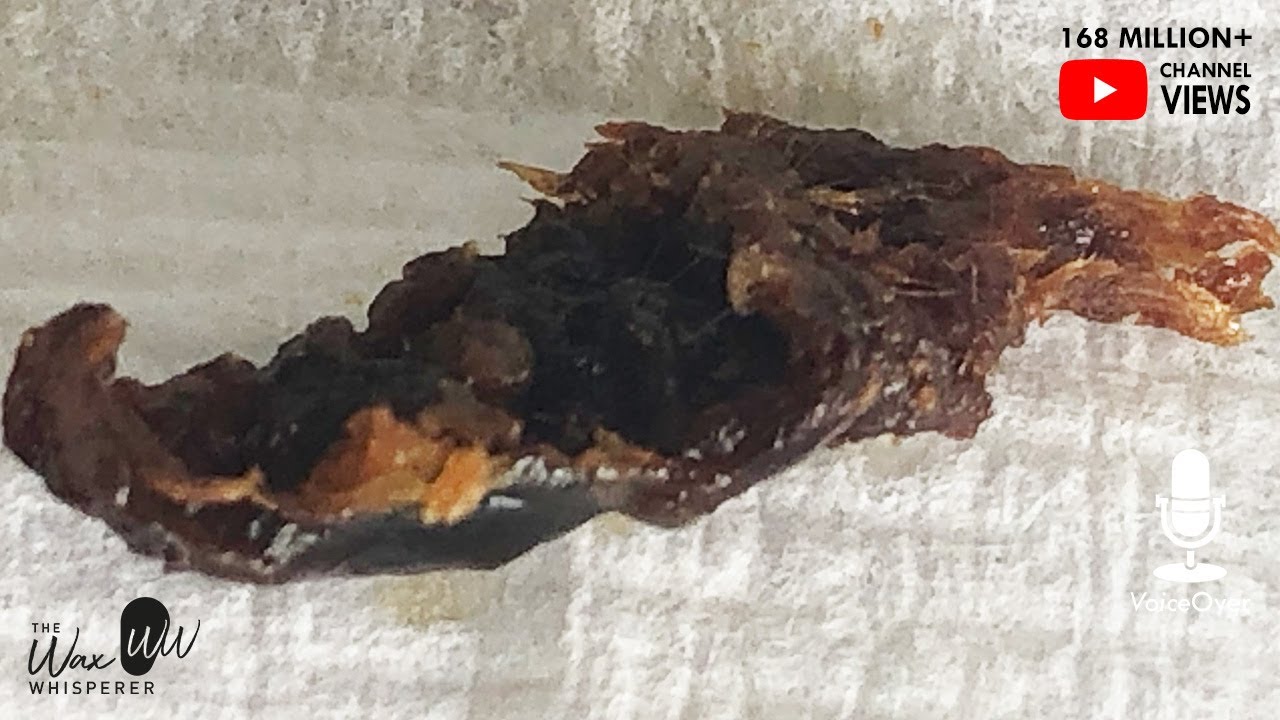 714 ABCC11 Wet Gene Ear Wax Removal YouTube