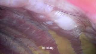 Thoracoscopic Intercostal Nerve Block After Video-assisted Surgery – Supplementary Video [446951]