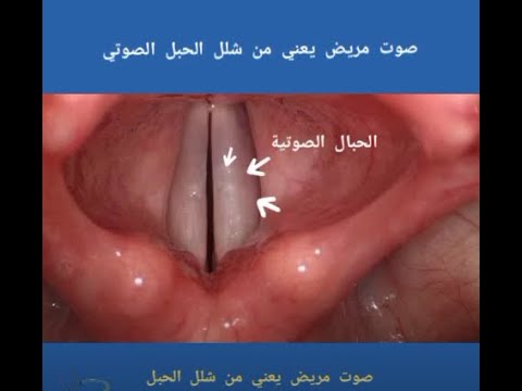 صوت مريض يعني من شلل الحبل الصوتي شاهد كيف أصبح الصوت بعد حقنة الفيلر