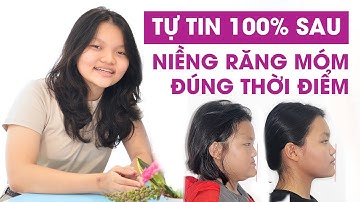 TỰ TIN 100% sau niềng răng móm đúng thời điểm