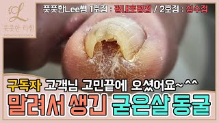 오그라들며 생긴 굳은살 동굴! 이제 편안하게 생활하세요 ingrown toenail - Fresh Foot 풋풋한리쌤 성수점 / 평내호평점 / 동탄역점