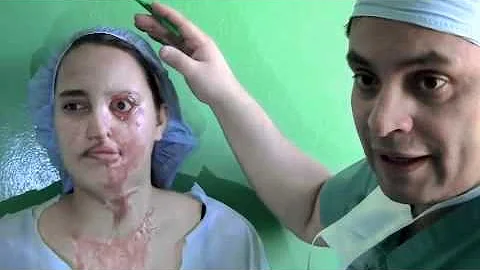 Moreano World Medical Mission: Acid Burn Victim Pa...