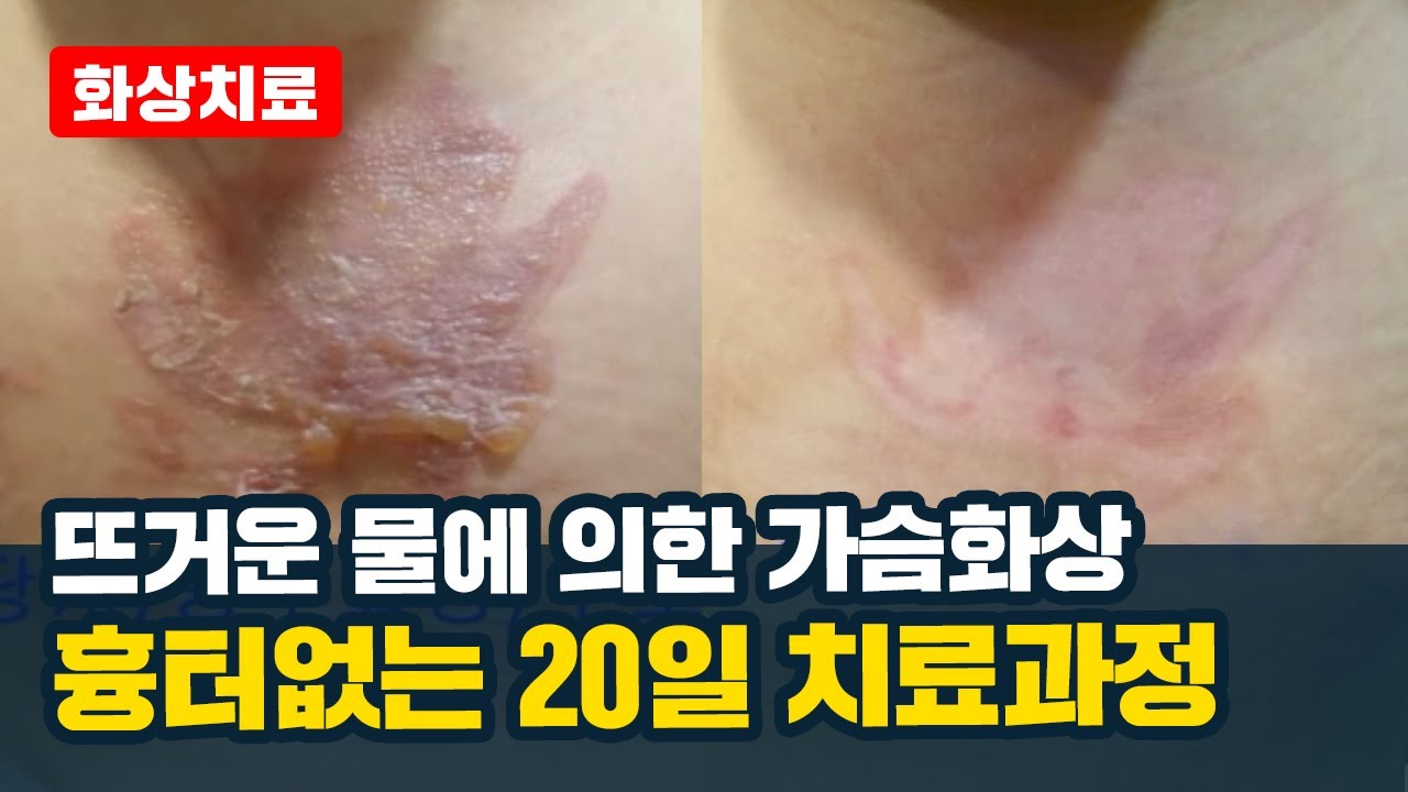 3도 화상 흉터 관리(정말 한 번도 안 되지만)는 계속 노력해야 할 것 같다. 12