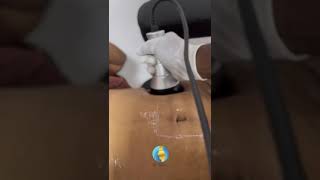 Cavitation for excessive fat reduction