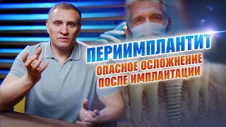 видео: Периимплантит –опасное осложнение после имплантации! #периимплантит #отторжениеимпланта #имплантация картинка: Периимплантит –опасное осложнение после имплантации! #периимплантит #отторжениеимпланта #имплантация