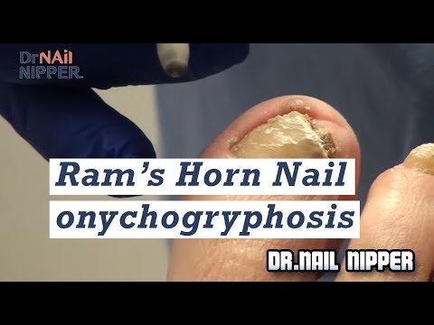 Video: Onychogryphose (Ram's Horn Nails): Ursachen & Behandlung