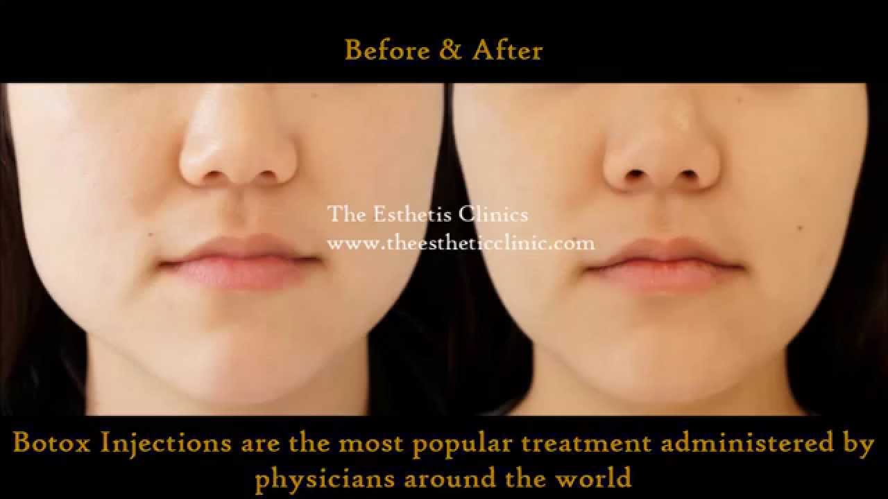 Botox Injection Treatment For Masseter Hypertrophy | Jawline Reduction  Treatment | Dr. Debraj Shome - Youtube