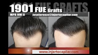 1901FUE Grafts. Frontal/temporal peaks restoration.NW II. Early growth. Injertocapilar.com.2158/2018