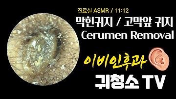 막힌 귀지   고막앞 귀지 (Ear Wax Removal)