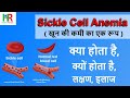 Sickle Cell Anemia | Sickle Cell Anemia in hindi | sickle cell anemia treatment in hindi | cause