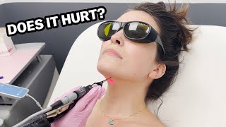 My Journey With Laser Hair Removal (The Truth)