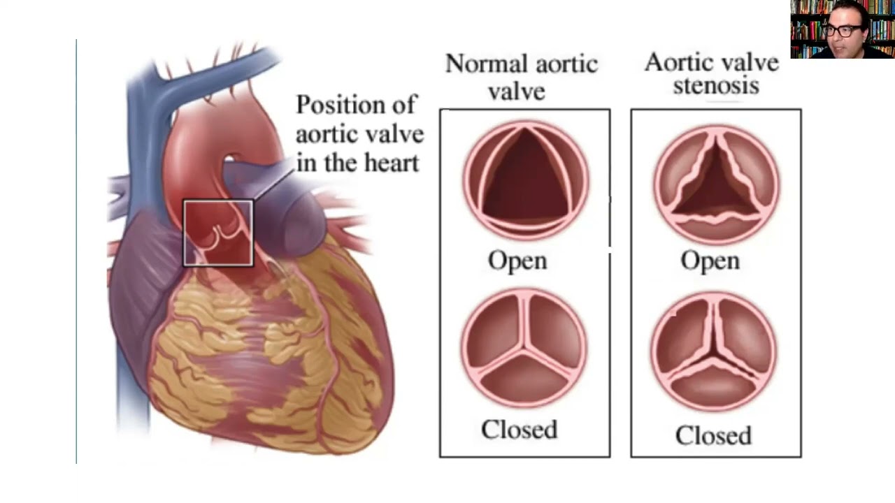 Аортальный стеноз что это такое. Пороки аортального клапана. Стеноз аортального клапана. Порок сердца стеноз аортального клапана. Стеноз двустворчатого аортального клапана.