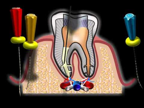 Video: Canale Radicolare Sul Dente Anteriore: Procedura, Costo E Altro