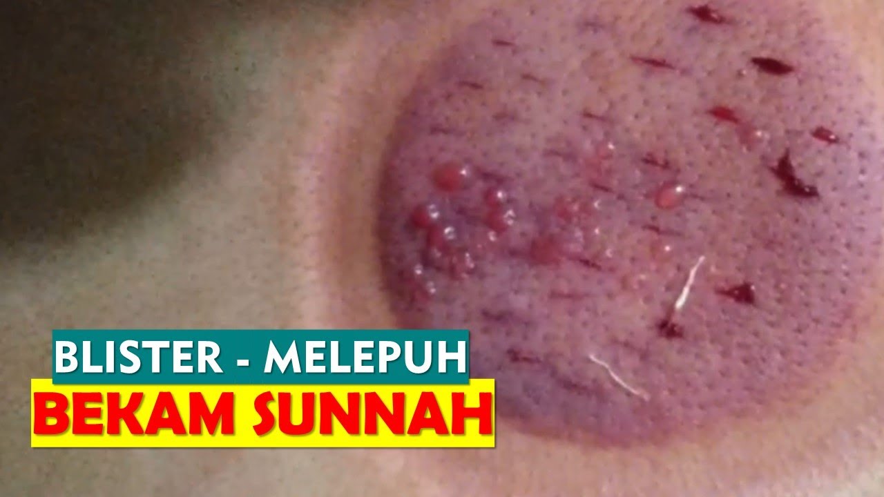 BEKAM SUNNAH : Cara Mengobati Blister Kulit Melepuh 