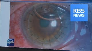 NEW TECHNIQUE FOR CORNEAL TRANSPLANT / KBS뉴스(News)