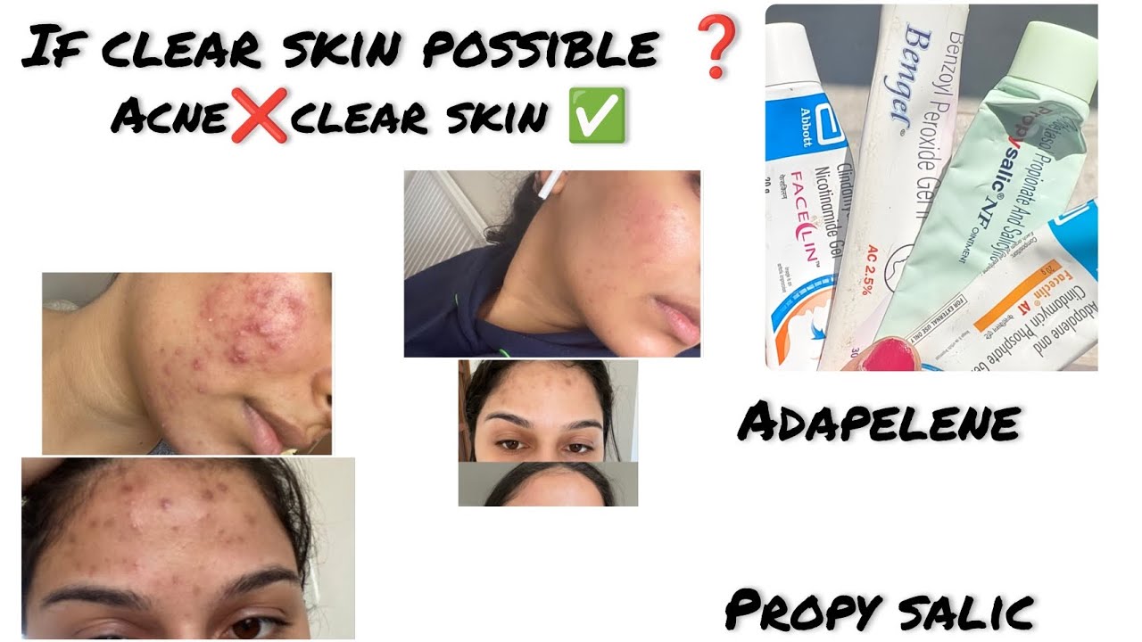 💫Clear Skin Possible ah❓!! Real Answer Inside ✅ #explore #explorepage #skincare #skin #youtube