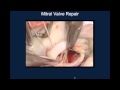 Webinar Playback - The Importance of Mitral Valve Repair Surgery for Patients