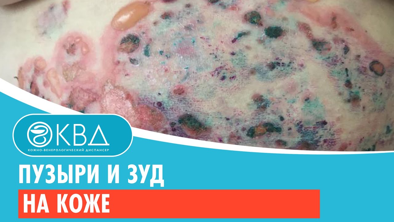 😰 Пузыри и зуд на коже. Клинический случай №956