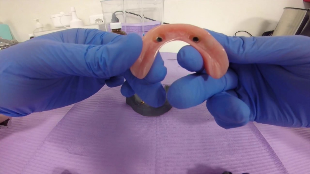 Carga de una sobredentadura inferior sobre implantes con ataches axiales.