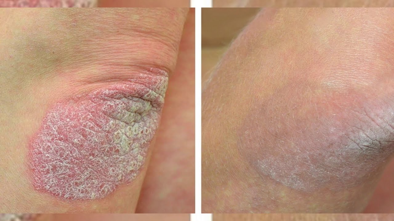 Псориаз на руках: фото начальной стадии, симптомы на пальцах рук - YouTube