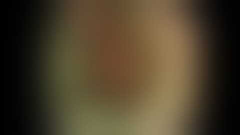 FTRD System clinical video