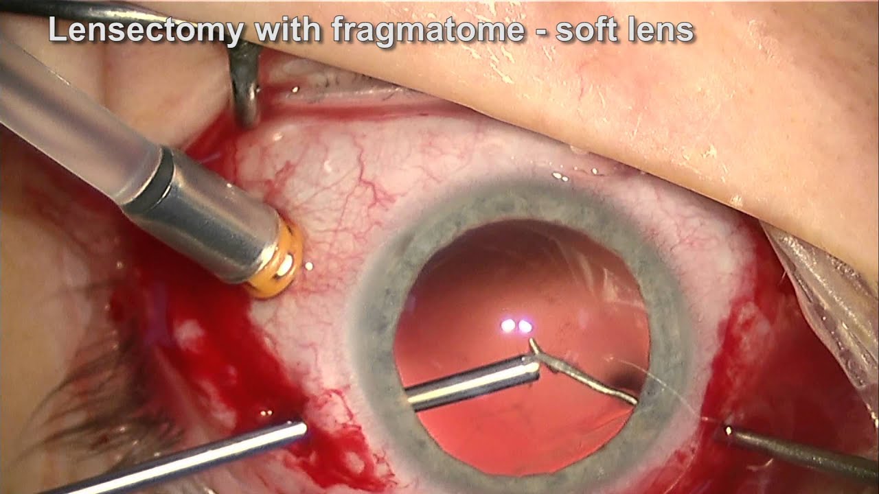Vitrectomy Lensectomy and ACIOL for Ectopia Lentis in