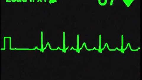 2nd Degree  Type II AV Block - ECG Simulator - Arrhythmia Simulator