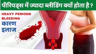 पीरियड्स में ज्यादा ब्लीडिंग का इलाज, Heavy Bleeding in Periods Treatment