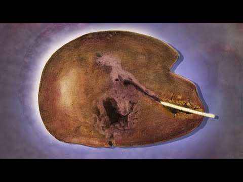 A Man Swallowed A Fishbone. This Is What Happened To His Liver.