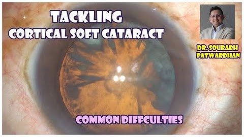 125 Cortical soft cataract- common difficulties..how do you approach case Dr Sourabh Patwardhan