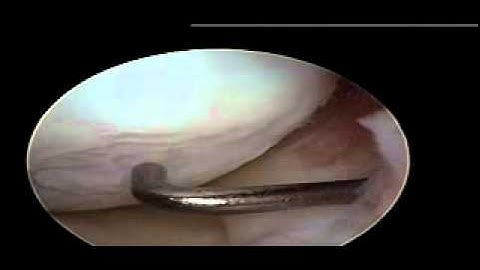 Microfracture Healed - Post Microfracture Knee Surgery 3 - Dr. Steven Struhl