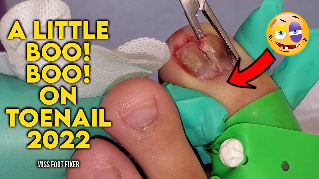 Patient having a little Boo! Boo! and Pigmentation of toenail full ...