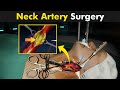 Carotid Endarterectomy Surgery - How Is Plaque Removed From Carotid Artery?