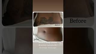 Brazilian Lymphatic drainage massage