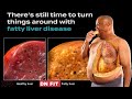 10 skin signs of liver diseasefatty liver fatty liver symptoms early signs of fatty liver disease