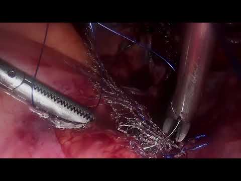 Video: Tratamentul Prolapsului Uterului La Domiciliu