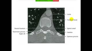 Radiological Anatomy Course Frcr Spine 3 Thoracic And Lumbar Spine Arabic Edition