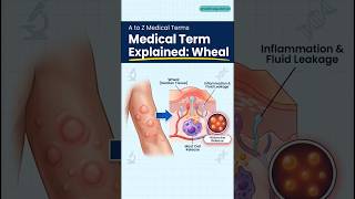 A to Z Medical Terms: Wheal Kya Hota Hai? #shorts #medicalawareness