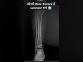 कोनसी bone fracture है comment करो 🩻 #xraychallenge #orthopedics #doctor #shortsfeed #xray #mbbs