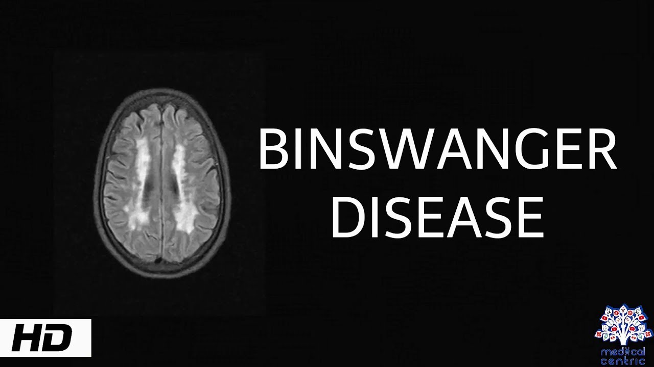 Binswanger disease, Causes , Signs and Symptoms, Diagnosis and