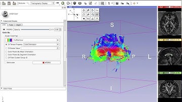DTI of Corpus Callosum