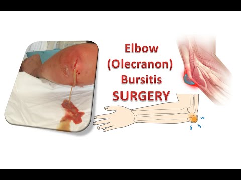 Elbow Bursitis Treatment (Olecranon Bursitis) - Surgery. Локтевой бурсит - Хирургическое лечение.