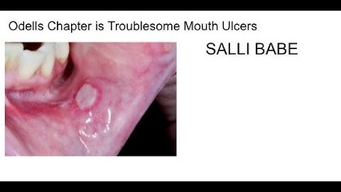 dental osces :  troublesome mouth ulcer ORE MFDS MJDF LDS OSCE video for UK dentists