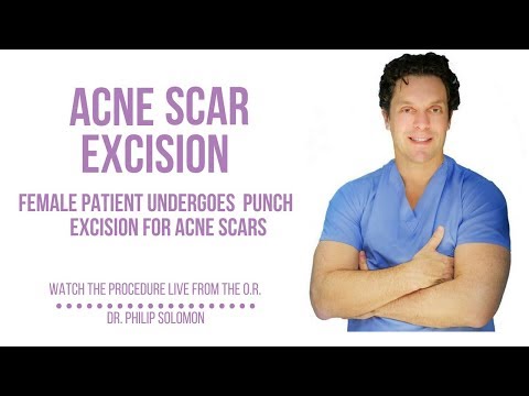 Acne Scar Excision | Dr. Philip Solomon