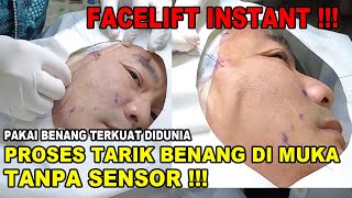 PROSES TARIK BENANG DI MUKA TANPA SENSOR !!!  FACELIFT INSTANT